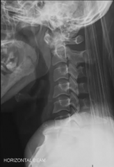 This patient complains of neck pain after a MVA. Interpret this cervical X-ray