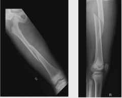 Young patient presents with pain over his thigh after trauma. Interpret this x-ray.