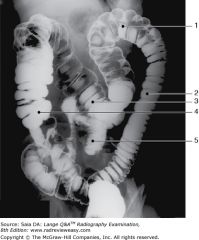 The structure indicated by the number 5 in Figure 6–11 is the
A sigmoid.  
B ileum.  
C cecum.  
D ascending colon.