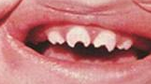 Dx?

					b) Hutchinson's triad
						i) Hutchinson's teeth
						ii) Interstitial keratitis
						iii) 8th nerve deafness
						iv) 
							A. Conical shaped teeth