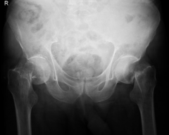 This is an X-ray of an elderly woman after a fall. What is the diagnosis ?