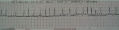 This ECG demonstrates which arrhythmia?