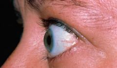 when the palpebral aperture is too large from retracted eyelids

~> often found in patients with Grave's disease