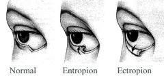 when eyelid tissues lose their elacticity they may droop away from the eye; tears can't drain effectively; patient may report "crying" as a symptom