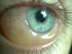 the edema of the conjunctiva