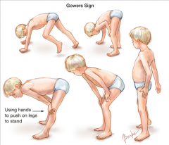 A child t`hat rises by walking hands up legs to compensate for gluteus maximus and quadriceps weakness. It is seen in Duchenne muscular dystrophy.