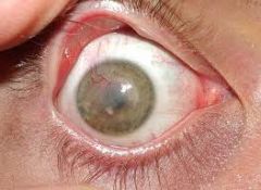 when a condition exists that doesn't allow adequate circulatory support for the cornea (i.e. edema, inflammation, or inadequate tear film oxygen content), new vessels will grow into the cornea which disturs its transparency