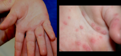 most common viral cause of Hand foot and mouth disease
