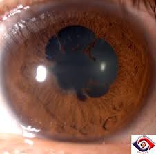 when the iris sticks to the lens as a result of inflammation to the iris