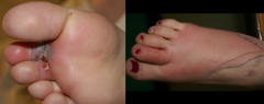 the bacterial infection is called?

bacterial infection that came in from cracks formed between toes of tinea pedis infectio