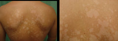 Dx?

				1) Light (hypopigmented) / coppery brown lesions
				2) On
					a) Trunk
					b) Shoulders
					c) Arms
					d) Rarely neck / face
				3) Sx
					a) Mild itching
					b) Summer - lesions don’t tan
				4) Dx
					a) Clinical ...