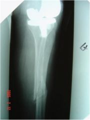 Hx:73 yo F underwent TKA 10 years ago. She sustained a prox tibial shaft periprosthetic fx p/ a ground level fall. xrays show that the fx involves the tibial component's stem w/loosening of the tibial component. Which  is the most appropriate tx? ...