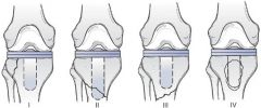 Revision with a long stem tibial component that bypasses the fracture is an appropriate treatment for tibial shaft fracture at the level of the implant with evidence of implant loosening. 
Haidukewych et al present a Level 5 review that states a ...