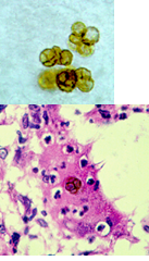 seen in what fungal infection?

Sclerotic bodies
				1) In lesions
				2) Thick-walled cells w/horizontal or vertical septa