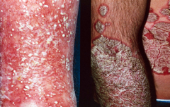 Dx?

			iv. Acanthosis - epidermal thickening
			v. Auspitz sign
				1) Parts of the epidermis thin - blood vessels prone to bleeding
			vi. Munro's abscesses
			vii. Usually painless - more of a cosmetic issue