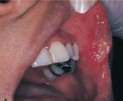 Major Aphthous Ulcer (Sutton Disease)
