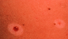 Dx?

- Heavy infiltration of the nevus by lymphocttes and histocytes
- Can be confused w/melanoma / lymphoma / dermatitis