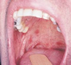 Herpetiform Aphthous Ulcer