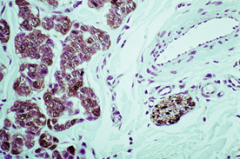 what staining - seen here - brings out malignant melanocytes