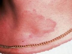 Appears as multiple areas of well-demarcated swelling of skin
May include itching (pruritus) 
Lesions are caused by localized areas of vascular permeability in superficial connective tissue 
