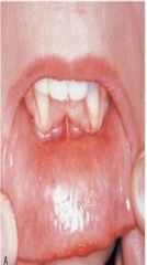 Contact Mucositis and Contact Dermatitis
 
*topical and systemic corticosteroids*
