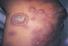 Erythema Multiforme
 
*remove cause or topical or systemic corticosteroids or antiviral medication*