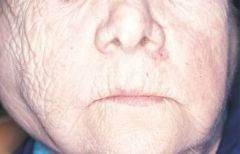 an autoimmune disease that affects the salivary and lacrimal glands, resulting in a decrease in saliva and tears; xerostomia and parotid gland enlargement