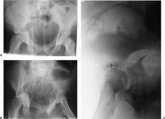 1-Dx/xrayF/ pathomneumic F & CTF (counterclockwise)
1.1 best method to test stability
2-Tx/surgical approach/indications 
3-MCC, CI
(5 elementary fx & accociated fx?)