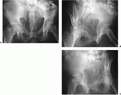 1-Dx/xrayF/ pathomneumic F & CTF (counterclockwise)
1.1 best method to test stability
2-Tx/surgical approach/indications 
3-MCC, CI
(5 elementary fx & accociated fx?)