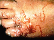 Dx?

		a. "Creeping eruption"
		b. Etiology/causes
			i. A. braziliense
			ii. A. caninum
		c. Transmitted by skin penetration
		d. Sx
			i. Raised erythematous / serpiginous / pruritic lesions
		e. Dx
			i. Clinical
		f. Rx
			i. Topi...