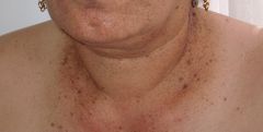 AD mutation in keratin 5
 
Black/brown macules in reticular distrubution in axillae, neck, inframmary, can be a/w perianal SCC