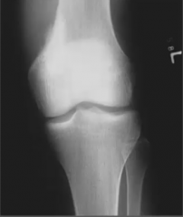  18 year old male complains of gradual onset of pain in the left knee. What is your diagnosis ?