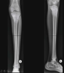 A 20 year old patient complains of pain in the proximal knee. What is your diagnosis ?