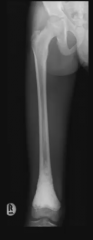 We are looking at a lateral x-ray of the right femur.

There seems to be a relatively ill-defined sclerotic lesion in the mataphysis that extends up to the growth plate.

A sun-burst appearance is noted, along with a Codman's trianlge. 

The mos...
