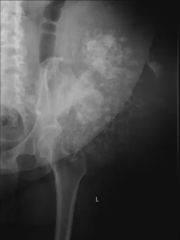 52 year old patient presents with a recently enlarging mass over her right hip. Her ESR was not high. What is your most likely diagnosis ?