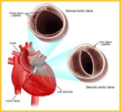 Congential aortic stenosis


 


(valve doesn't open wide enough)