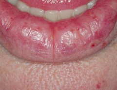 Erythema and scale of lower lip