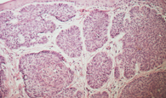Most common form of basal cell carcinoma

telangiectasias