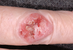Dx?

			i. 20% nonmelanoma skin cancers
			ii. Some mets risk
			iii. Etiology
				1) Low mets
					a) Actinic damage
				2) High mets
					a) Prior radiation
					b) Thermal injury
					c) Draining sinus
			iv. Organ transplants (253x ...