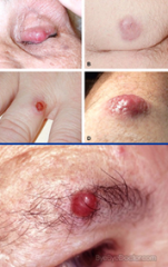 skin carcinoma
			- 80% from virus
			- < 20% 5 yr survival