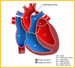 Coarctation of the aorta


(R ventricle feeds into descending aorta via patent ductus areriosus)