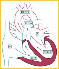 Pulmonic valve stenosis