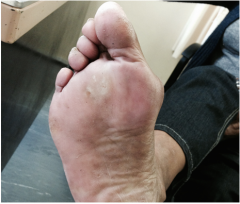 A 60 year old female presents with forefoot pain under the 2nd MTP joint. She has a vlagus deformity of the first MTP joint and also a deformity of the 2nd lesser toe. The pain she experiences is associated with shoe wear. What is your most likely...