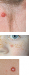what is a
spitz nevus?