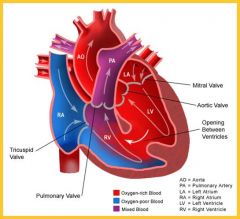 Ventricular Septal Defect (VSD)


 


(2nd most common CHD)