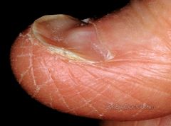 nail curves upward may indicate iron deficiency anemia