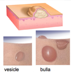 Describe VESICLES ("little bladder"). What is a large blister called?