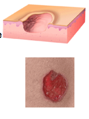 Ulcers are complete loss of the ____________ in addition to part of the ___________. Do they heal with scarring? What lesion doesn't?