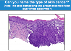 What type of skin cancer?