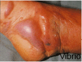 This is cellulitis caused by Vibrio vulnificans (seawater/seashell contact). The most common cause of cellulitis is Group A strep and S. aureus. Other causes include Group B strep in diabetics/chronically ill, Enterobacteriaceae in immunocompromis...